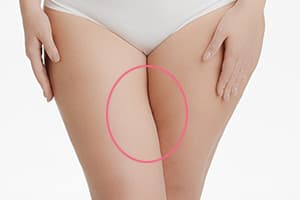 脚を閉じたとき隙間ができない内ももの状態