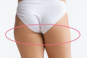 お尻と太ももの境目がはっきりしない状態