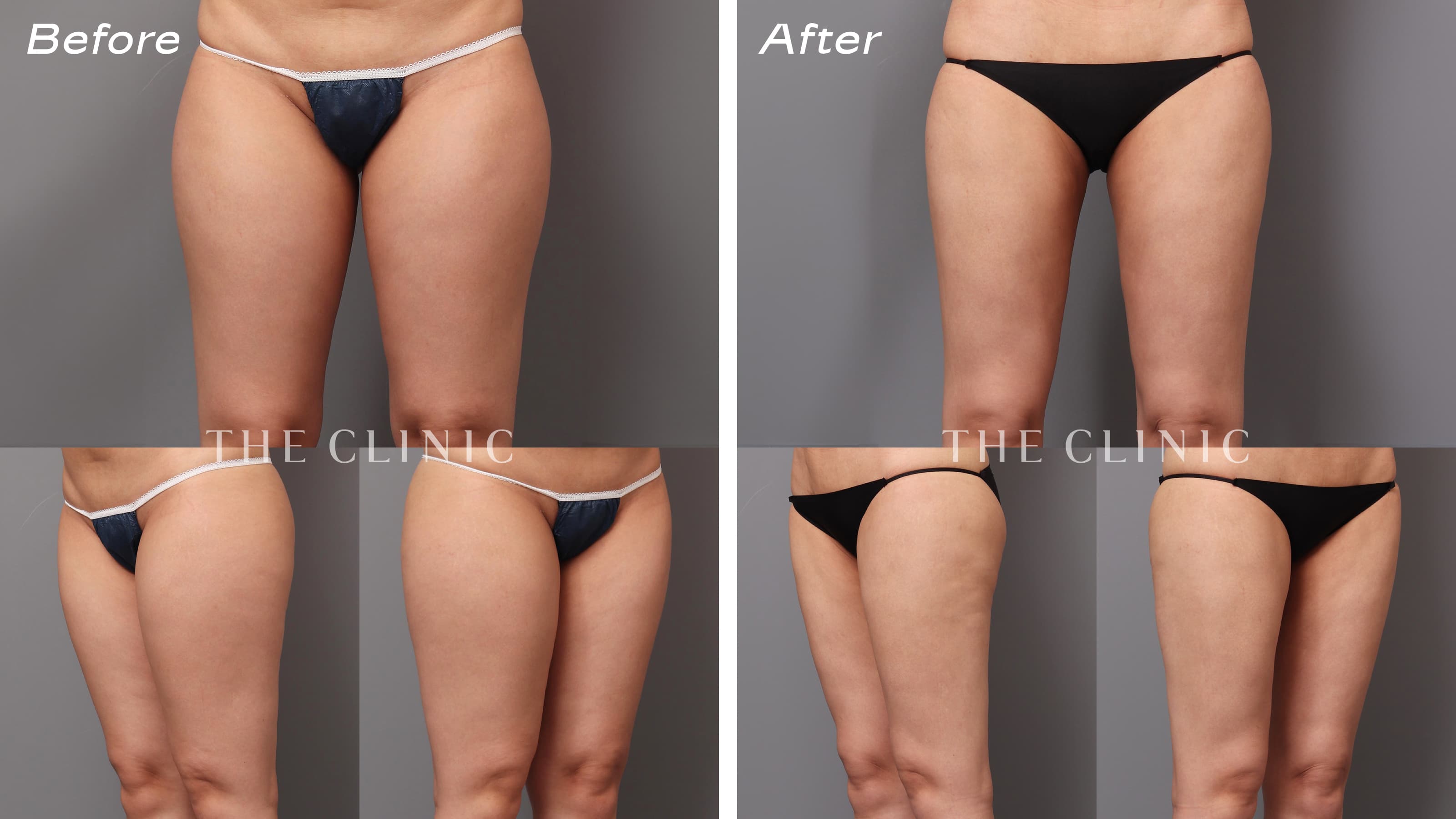 360脂肪吸引 Before/After