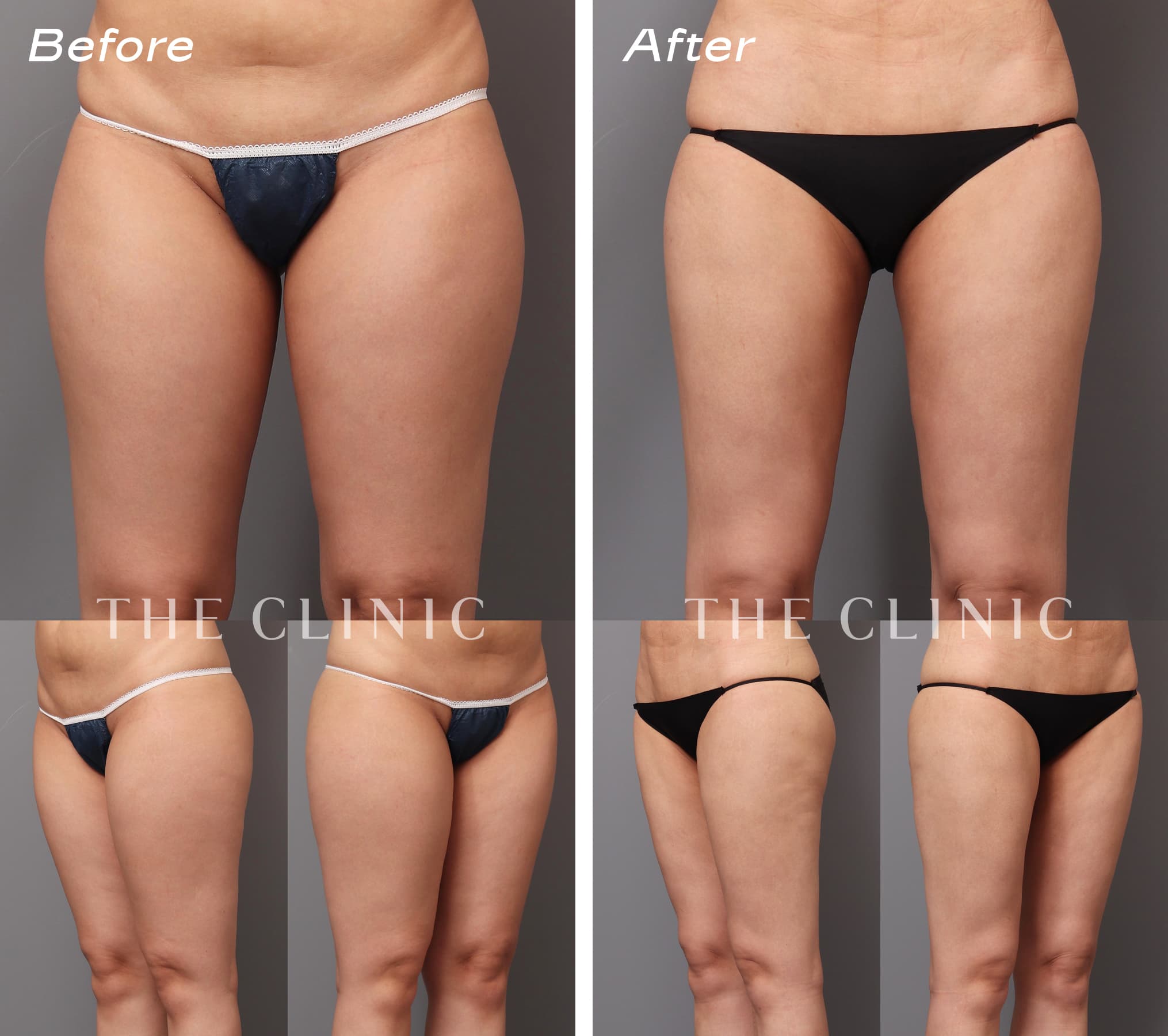 360脂肪吸引 Before/After