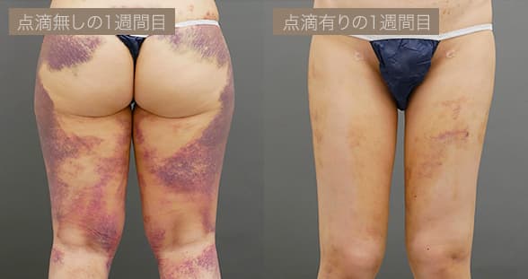 点滴ありとなしの比較 - 左:点滴無しの1週間目、右:点滴有りの1週間目