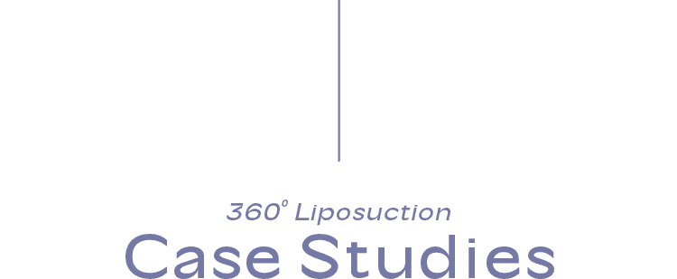 360° Liposuction Case Studies